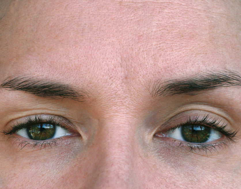 eyelid syndrome